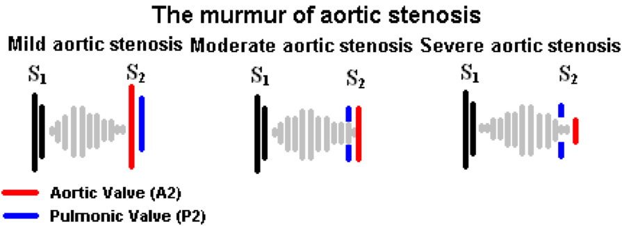 Heart Sounds