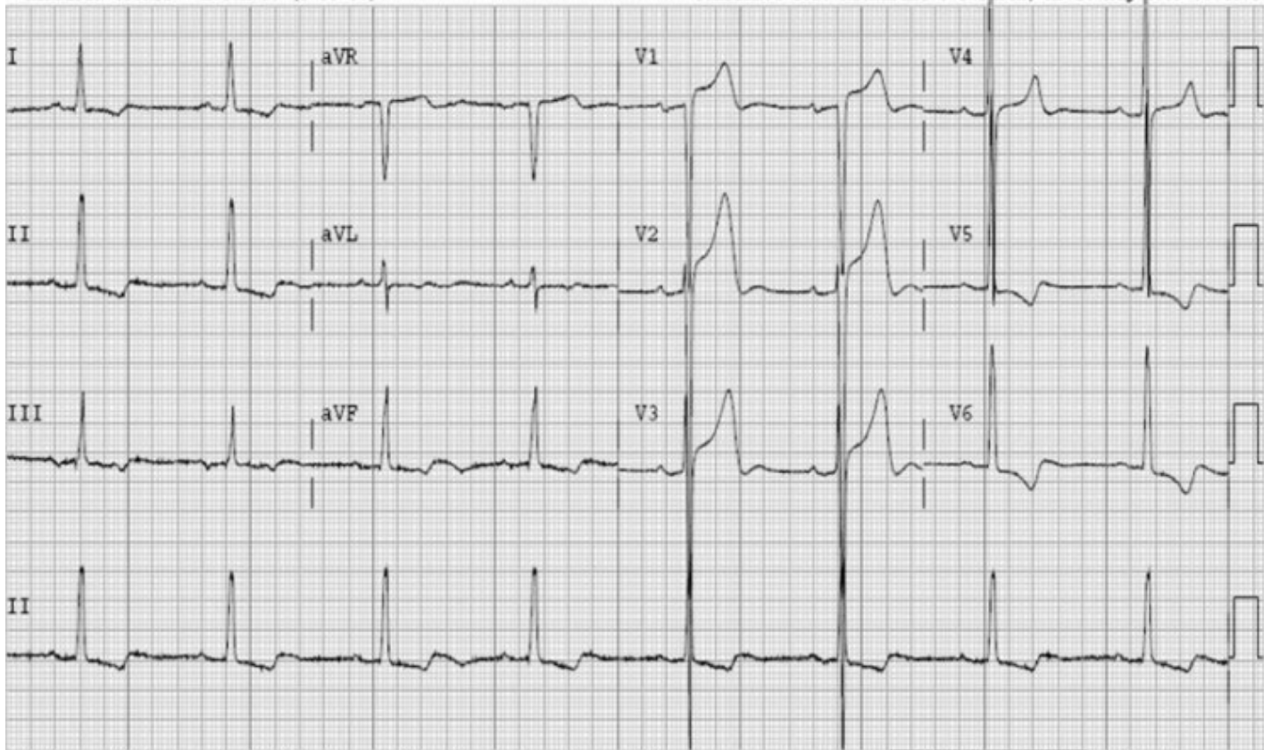 diagnosis of aortic stenosis - Echo Sounds